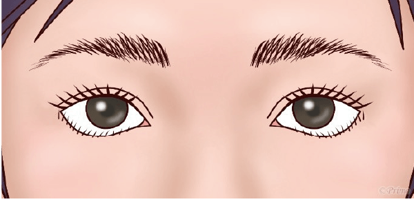 下眼瞼拡大修正術 前の目元イラスト